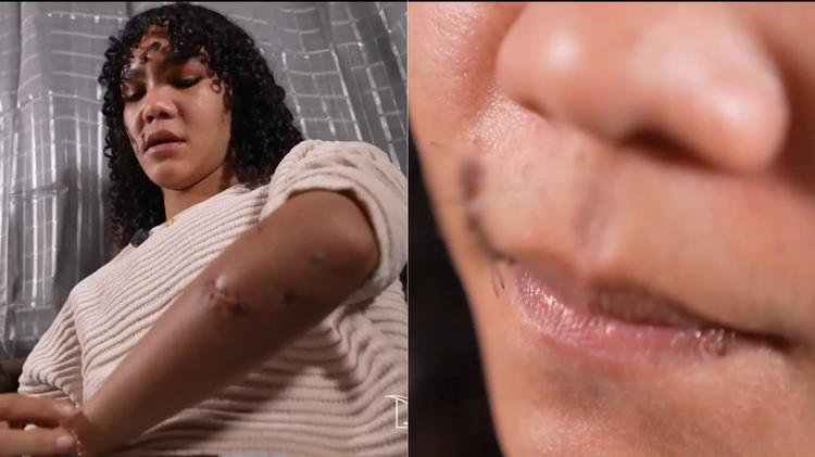 ‘Não conseguia me olhar no espelho’, diz mulher trans atacada com garrafa em Rosário, no MA