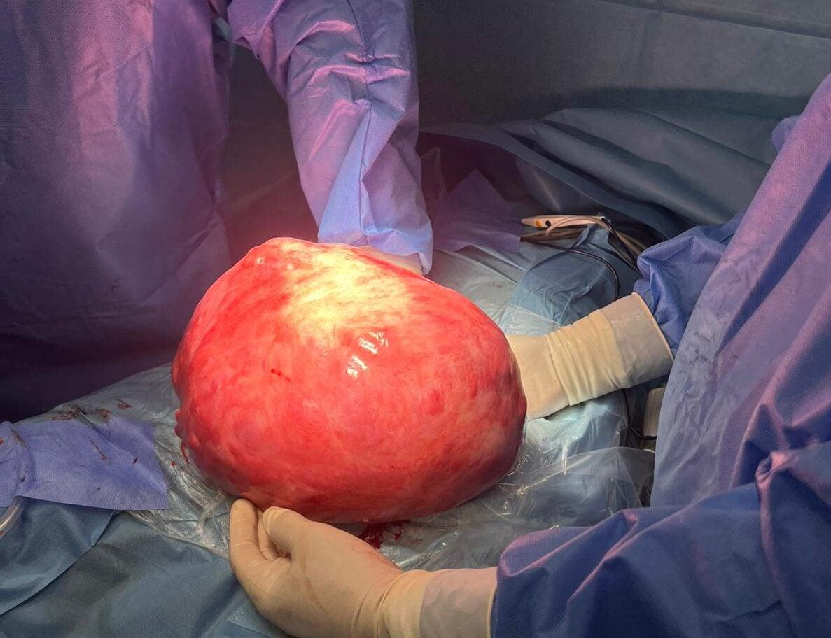 Salerno, asportato un tumore di 10 chili alla clinica Tortorella: eccezionale intervento del professor Polichetti