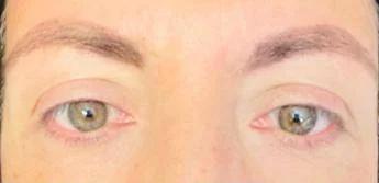 Visione annebbiata o distorta spia di retinopatia. "Ne soffre il 30% dei diabetici, prevenzione l'arma più efficace"