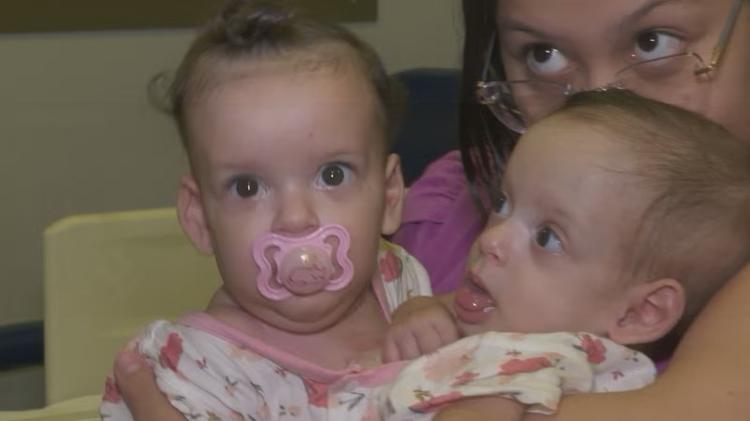 Siamesas de São Paulo passam por nova cirurgia em Goiás durante preparação para serem separadas