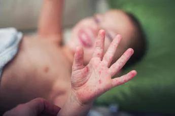 Morbillo, aumentano casi e ricoveri. Bassetti: "In Liguria focolaio senza precedenti, l'Italia rischia gravissima epidemia"