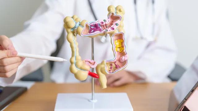 Pacientes com câncer colorretal têm medicamento aprovado pela Anvisa