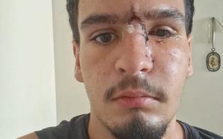 Jovem que perdeu a visão após ser atingido por bala de borracha da PM irá processar o estado do RJ