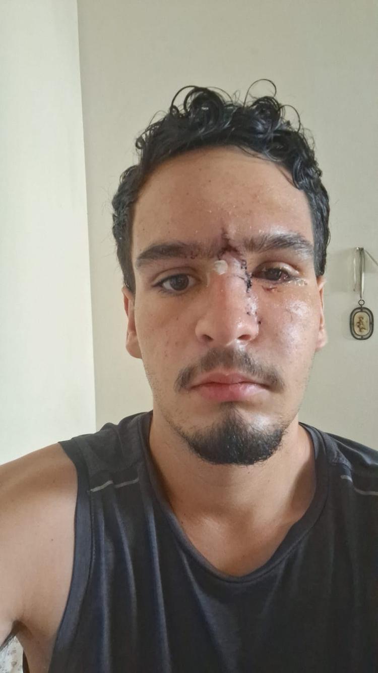 Jovem que perdeu a visão após ser atingido por bala de borracha da PM irá processar o estado do RJ
