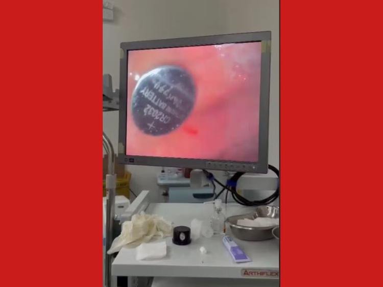 VÍDEO: Médicos retiram bateria de lítio do estômago de criança de 1 ano e 9 meses no Acre