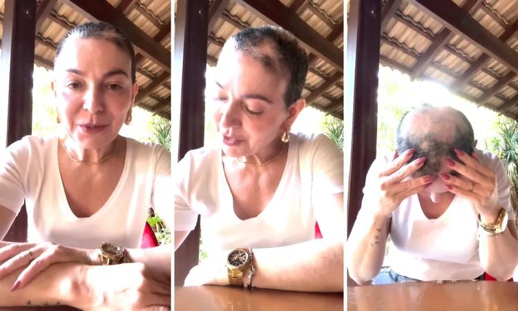 Alopecia areata: doença que fez mãe de Lucas Lucco perder cabelo tem tratamento de alto custo e afeta a saúde mental