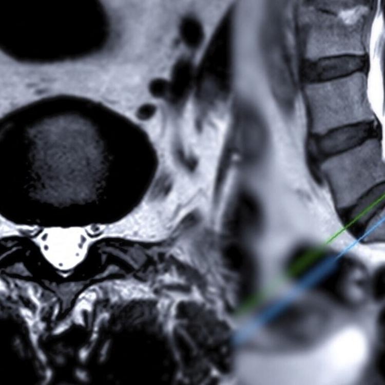 Un anticorpo può rigenerare il midollo spinale dopo un trauma