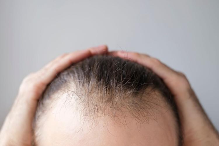 Minoxidil Oral