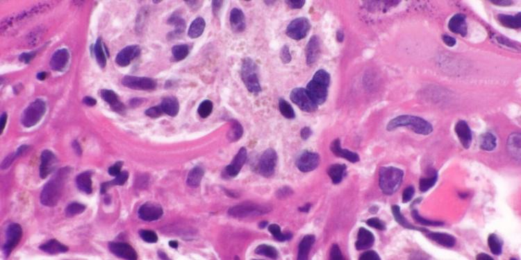 Melanoma, svolta con il vaccino personalizzato a mRNA: recidive ridotte del 42%