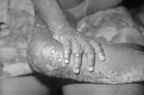 Casos de Mpox no estado do Rio de Janeiro crescem 77% em comparação ao ano passado