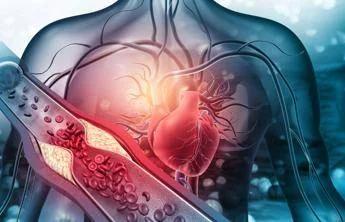 Arterosclerosi, studio: "Nuova molecola riduce di più il colesterolo cattivo"