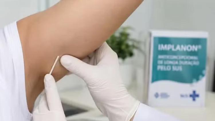Anvisa amplia para cinco anos validade do implante contraceptivo; dispositivo é distribuído no SUS