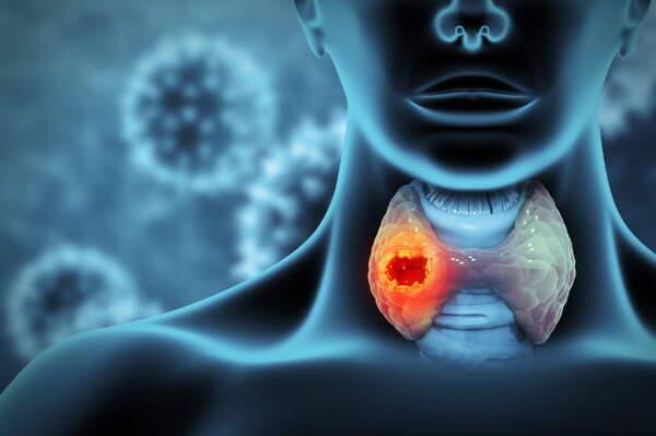 Tumore della tiroide