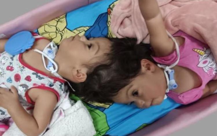 Gêmeas que morreram em cirurgia de separação das cabeças em SP sobreviveram por 2 e 12 minutos