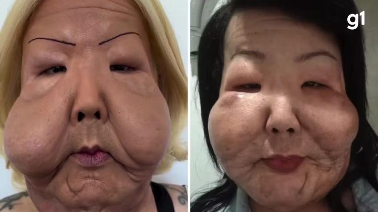 'Juju do Pix': seis meses após primeira cirurgia reparadora, médico divulga novo 'antes e depois'