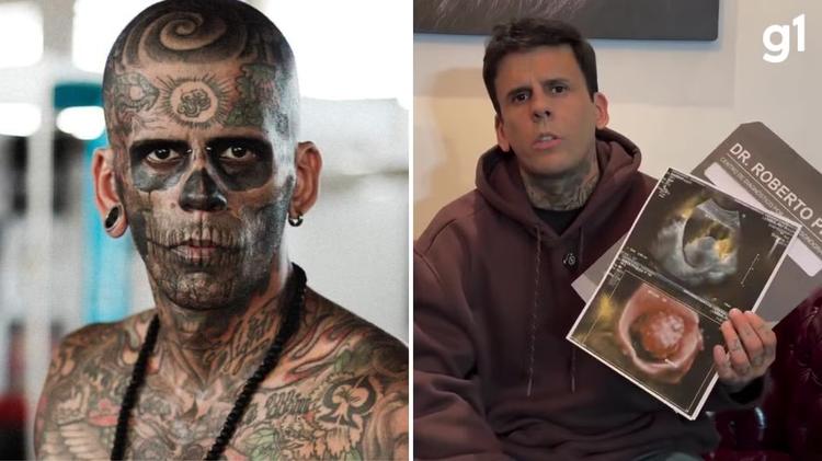 'Homem mais tatuado do Brasil' descobre tumor na bexiga horas antes de nova sessão de remoção de tatuagens