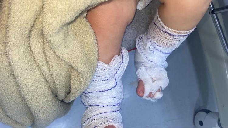 Bebê de 11 meses tem queimaduras de 2º grau após banho em escola no RS, diz mãe; polícia investiga o caso