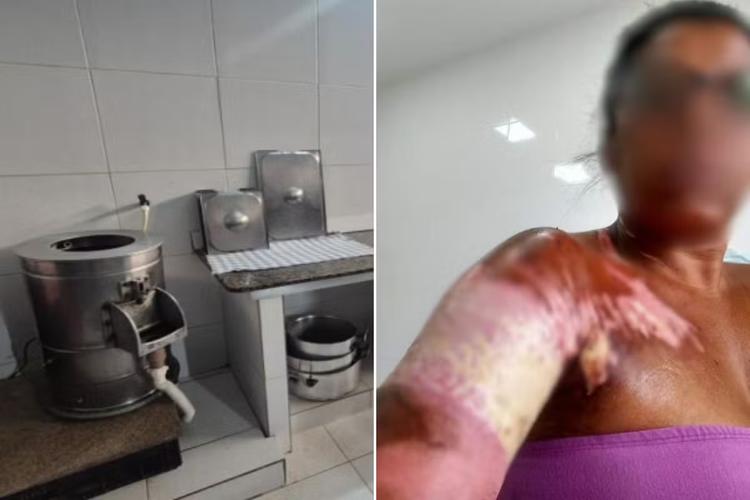 Restaurante é condenado a indenizar ex-funcionária que se queimou fritando batatas; valor pode passar de R$ 90 mil
