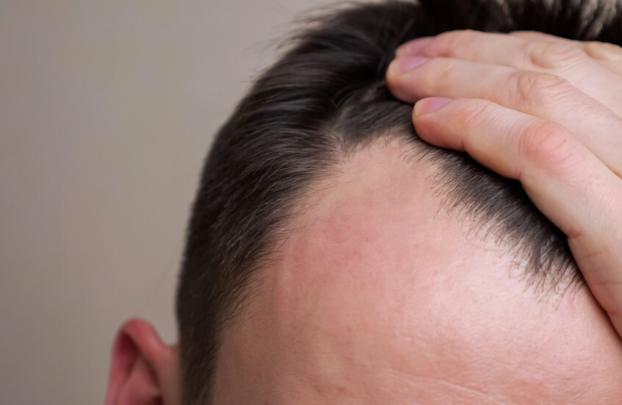 دراسة تربط أدوية إنقاص الوزن بتساقط الشعر لدى الرجال
