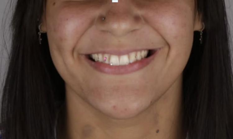 Jovem dá golpe após&nbsp;colocar cristais nos dentes e é presa ao ser reconhecida por dentista em parque, diz&nbsp;profissional