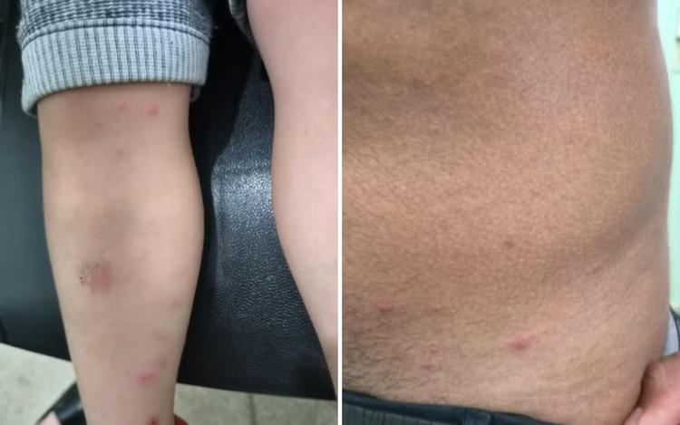 Prefeitura de Brodowski, SP, descarta sarna humana em pacientes com sintomas de coceira e manchas na pele
