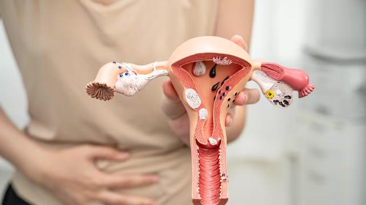 Endometriose: doença ignorada por séculos já tinha sintomas descritos na Antiguidade