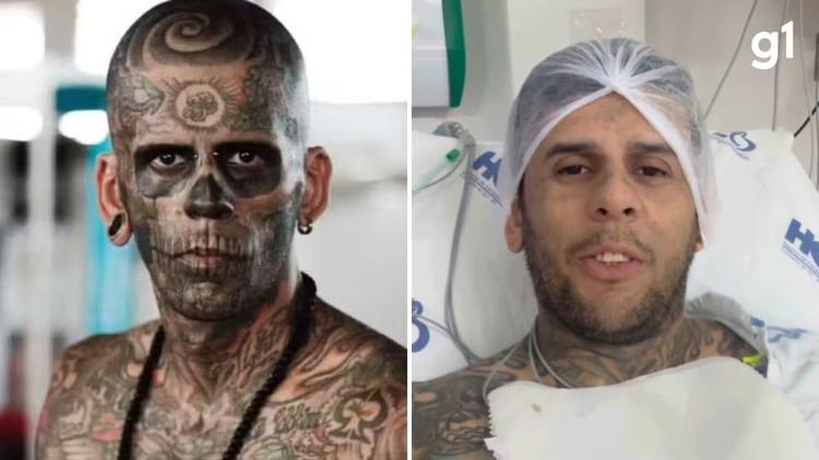 'Homem mais tatuado do Brasil' passa por cirurgia para retirar tumor na bexiga