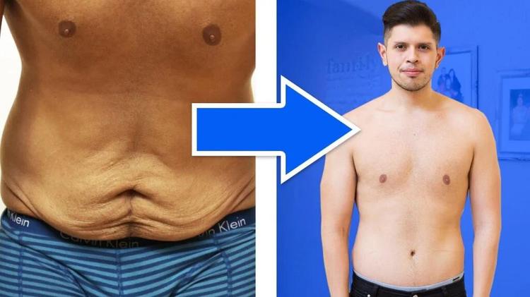 Pelle in eccesso dopo un grande dimagrimento: quando serve la chirurgia, cosa comprende, quanto costa e quando la paga il Servizio sanitario
