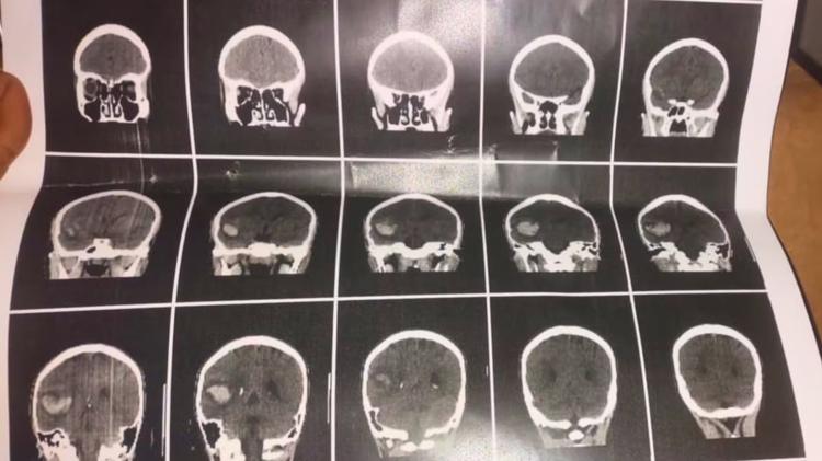 Adolescente é agredido com pá na cabeça por aluno em escola cívico-militar e sofre hemorragia cerebral
