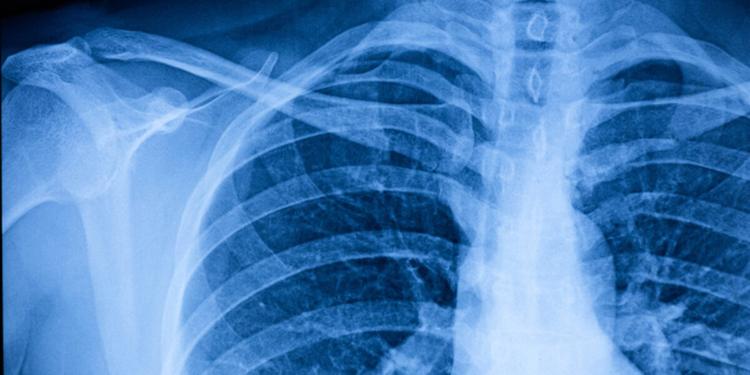 Adenocarcinoma polmonare, il tumore diagnosticato al Papa: che cos'è, chi colpisce e come si cura