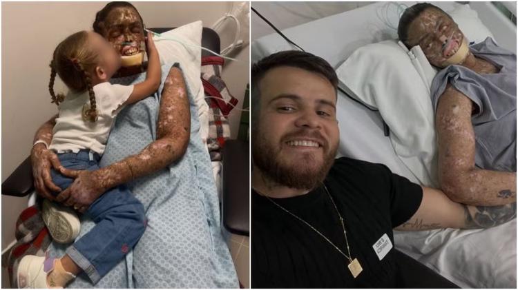 O que é o xeroderma pigmentoso, a doença rara que faz do sol um risco de câncer e causou a morte de Káh Felipe