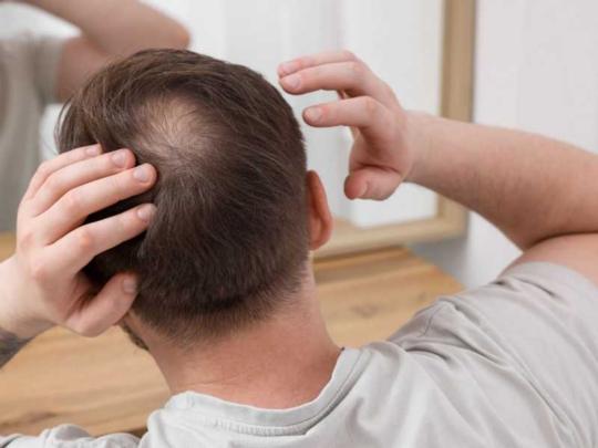 دراسة تعيد إحياء وصفة صينية قديمة لعلاج الصلع نهائياً