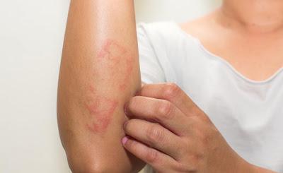 🧑🏻‍⚕️ "È solo stress!": la frase da non dire a chi soffre di psoriasi