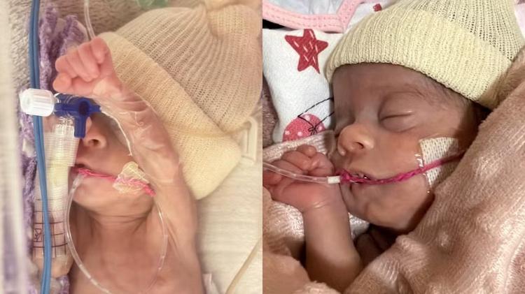 'Guerreirinha': bebê que chegou a pesar 620 gramas supera fase crítica após mais de 60 dias na UTI neonatal