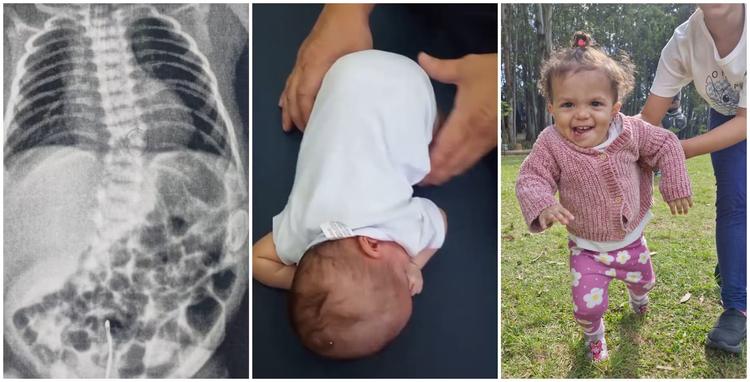 Como a fisioterapia precoce mudou a trajetória de uma bebê prematura com risco de não andar e nem falar em SP