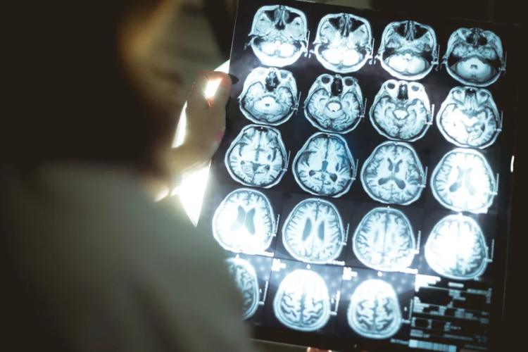 Des scientifiques japonais font une découverte immense sur la maladie d’Alzheimer