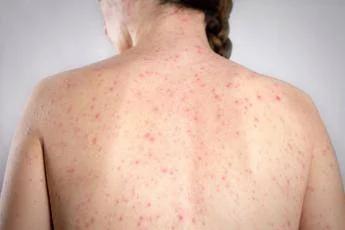 Morbillo, è allarme negli Usa. Italia prima per casi in Europa in in primi 6 mesi 2026