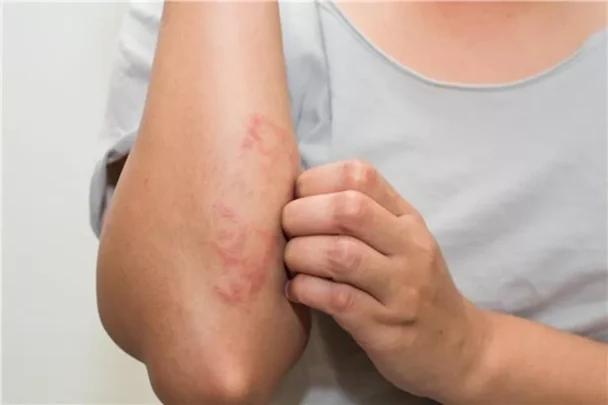 التوتر يشعل الإكزيما.. اكتشاف علمي يغير فهم المرض