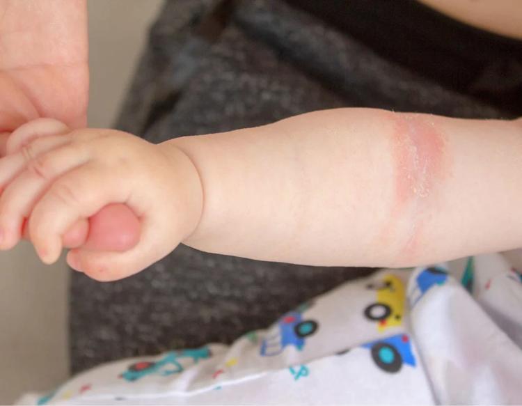 Close-up of heat rash (prickly heat) on a newborn baby’s hand, showing small red bumps in the skin folds.