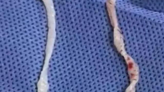 Mulher cozinhava rãs e acabou com dois parasitas de 10 cm no corpo
