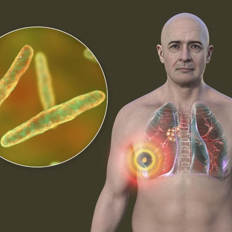 Tubercolosi, arriva un test che trova i casi nascosti