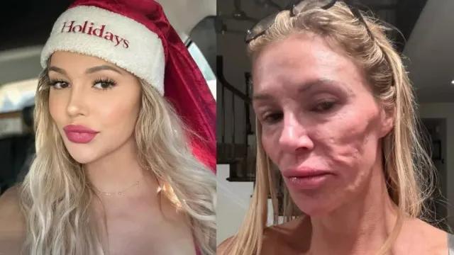 Ex-modelo que teve rosto 'derretido' revela origem da doença