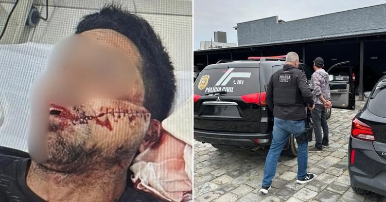 Homem suspeito de decepar dedo de vítima é preso em Navegantes; caso aconteceu após atropelamento de cão&nbsp;