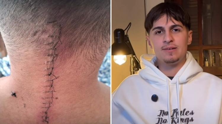 Tetraplégico após cirurgia, jovem volta a andar e surpreende médicos: ‘Deus faz milagres’