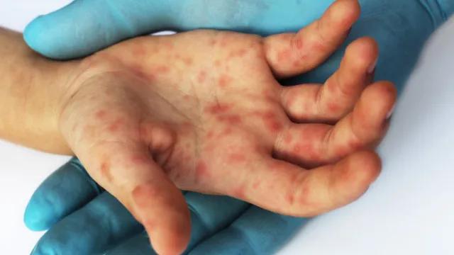 SP confirma segundo caso importado de sarampo