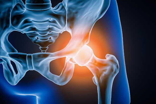Artrosi dell’anca: coxartrosi