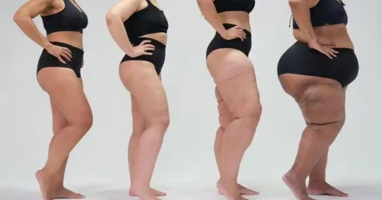 Lipedema: saiba mais sobre a doença confundida com obesidade e celulite