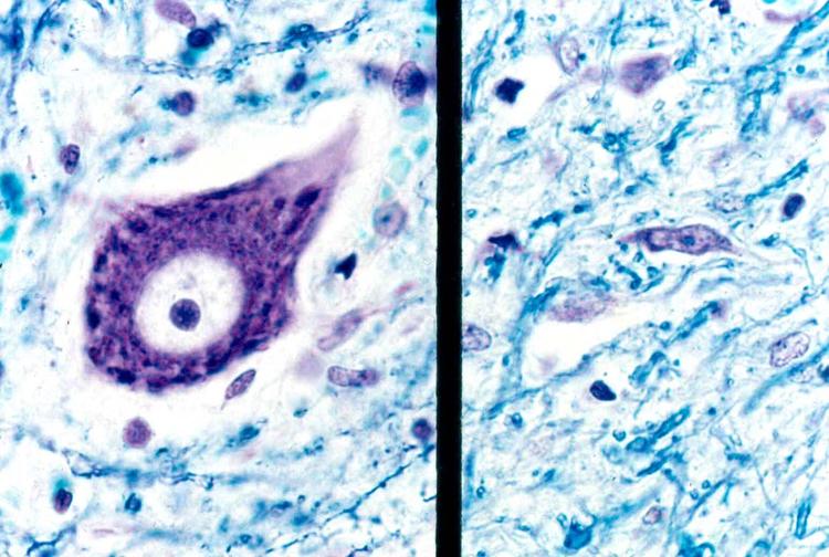 Proteínas no sangue mudam anos antes da ELA e podem prever quando a doença vai começar