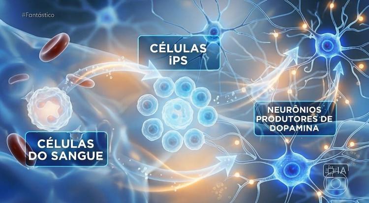 Pesquisa no Japão usa terapia celular e apresenta resultados inéditos no tratamento do Parkinson