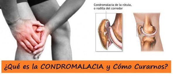 CONDROMALACIA rotuliana 【Ejercicios】 para evitar dolor de rodilla